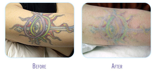tattoo removal cost laser tattoo removal does laser tattoo removal ...