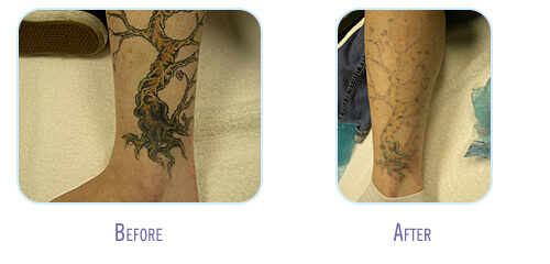 Laser Tattoo Removal Procedure at BodyLase after 4 Treatments