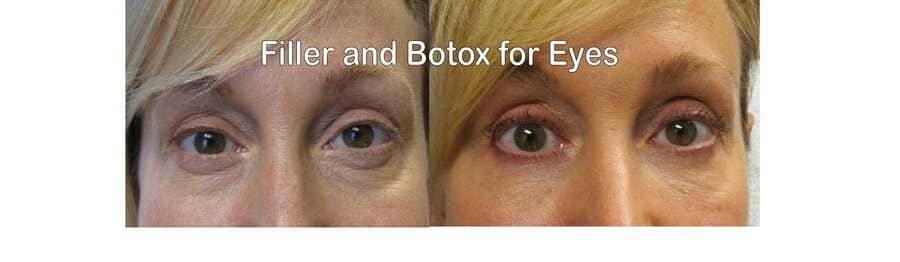 Botox and Filler for Eyes