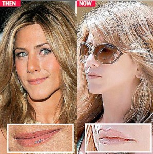 Jennifer Aniston before and after Juvederm results