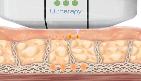how ultherapy works no toxins