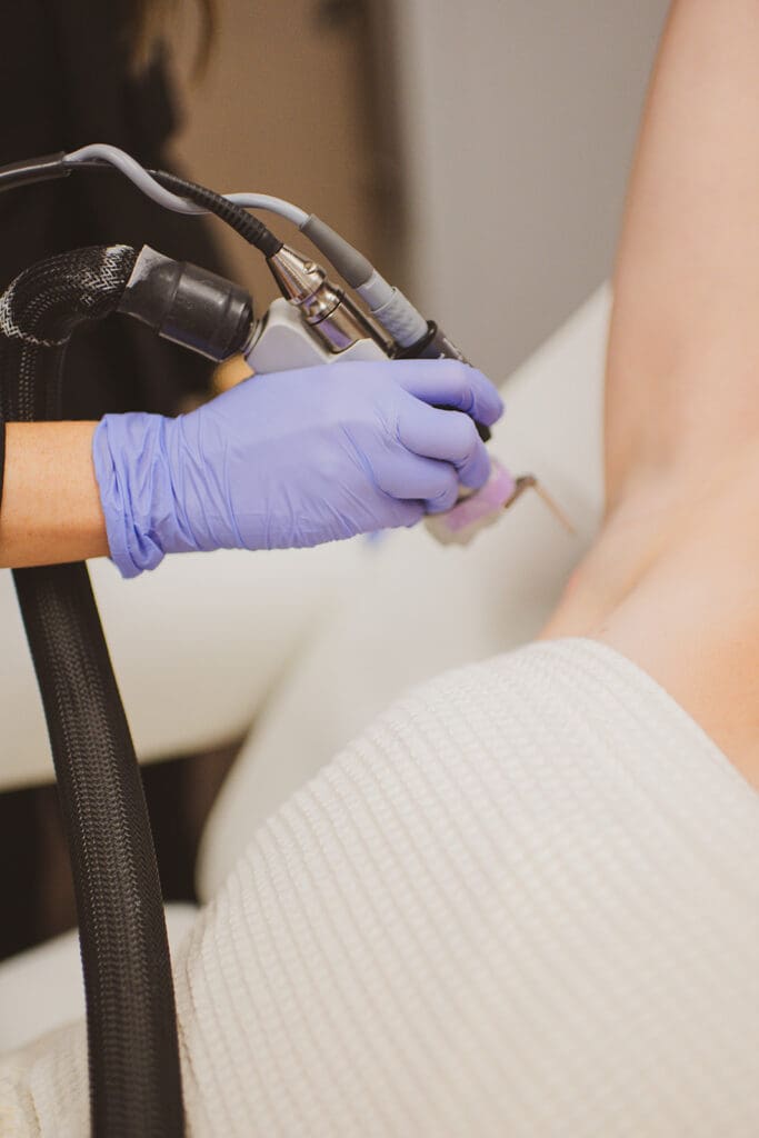 Female patient receiving laser hair removal treatments at BodyLase