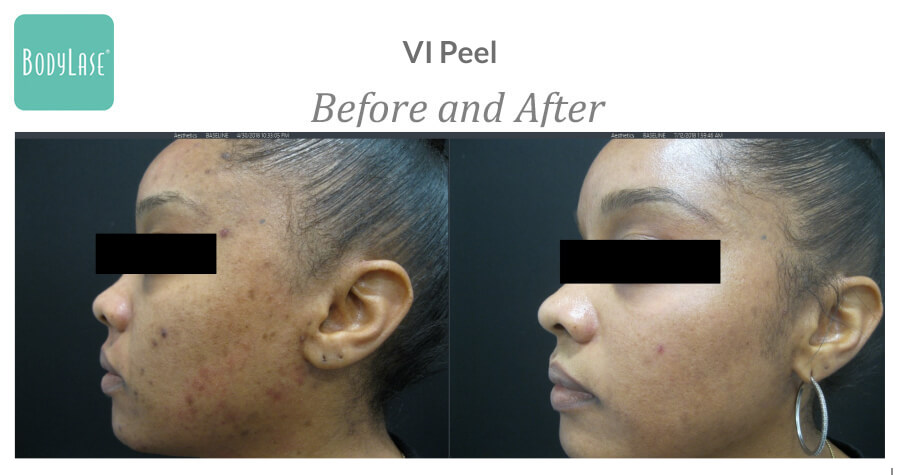 Before and after chemical peel treatment results