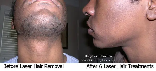 Laser Hair Removal Before and After