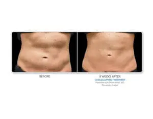 coolsculpting before and after
