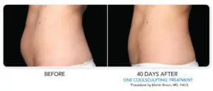 coolsculpting treatment before and after