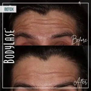 Botox Before and After