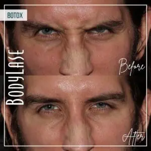 Botox Before and After