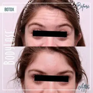 Botox Before and After