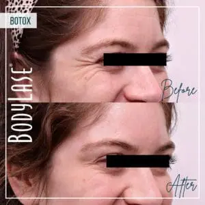 Botox Before and After