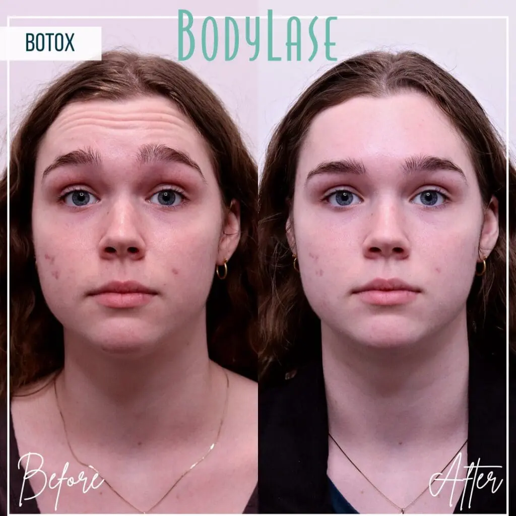 Dysport vs Botox 2 Botox Before and After