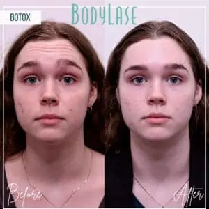 Botox Before and After