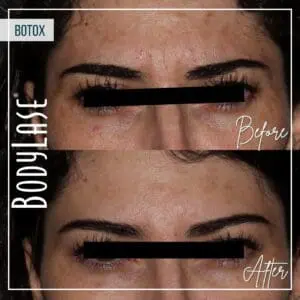 Botox Before and After