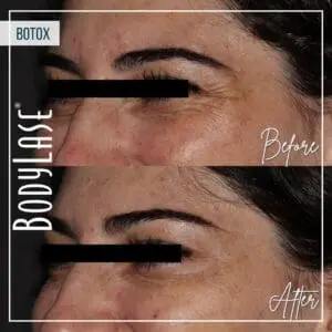 Botox Before and After
