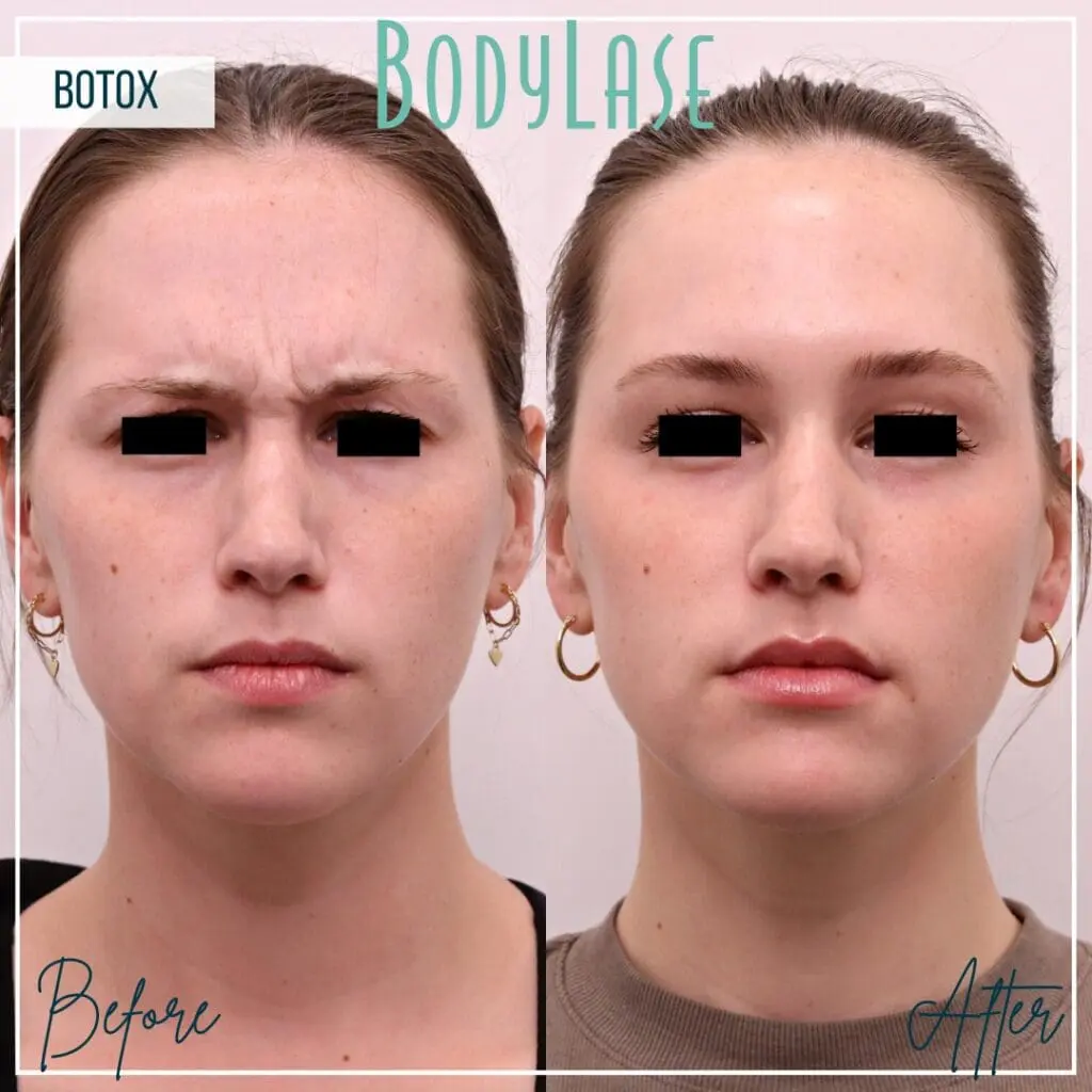 Botox Before and After