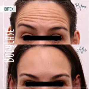 Botox Before and After