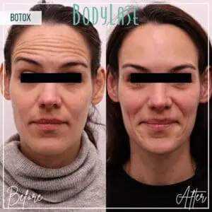 Botox Before and After