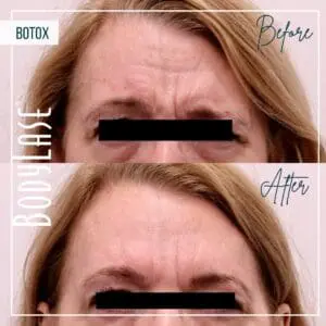 Botox Before and After