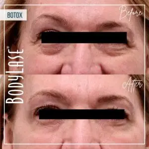 Botox Before and After