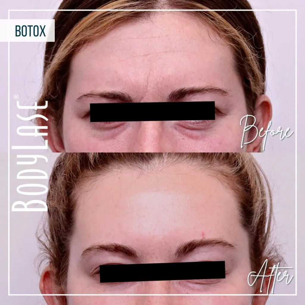 Botox Before and After