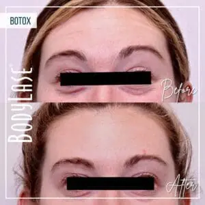 Botox Before and After