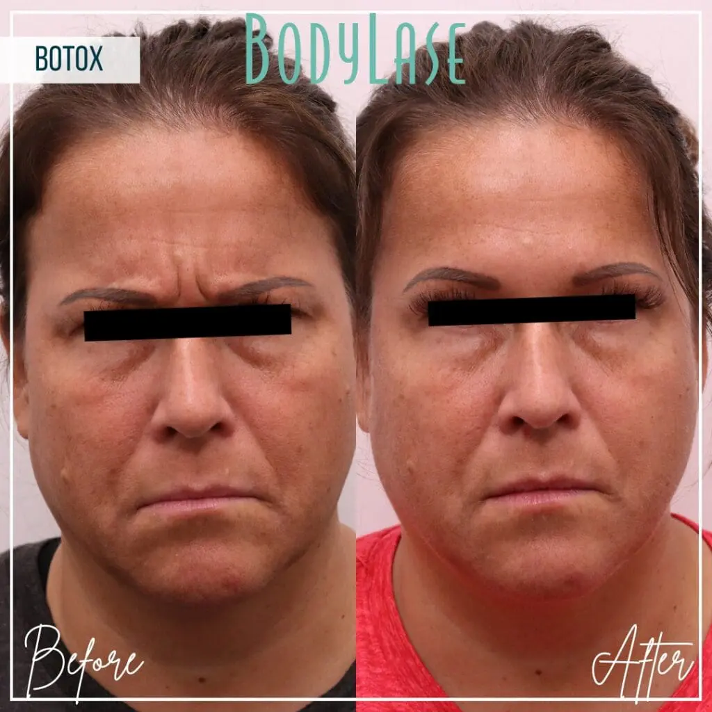 Botox Before and After