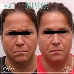 Botox Before and After