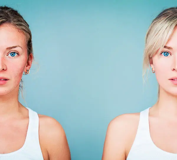 Model Shows Off Skin With and Without Rosacea