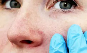 Model with Red Veins Visible on the Nose