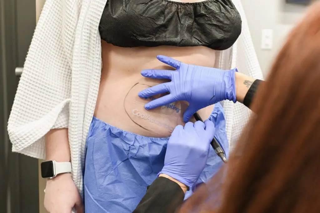 CoolSculpting Before and After 3 CoolSculpting® Elite treatments at BodyLase