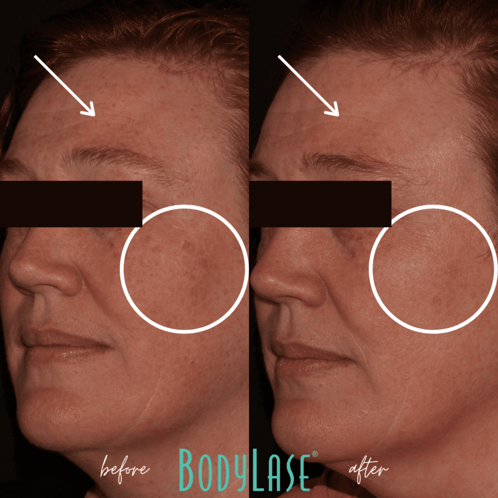 Before and after IPL results