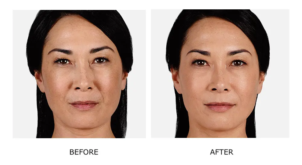 New Year, New Glow: Beauty Resolutions for a Med Spa Makeover in 2024 3 Before and after JUVÉDERM® results