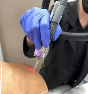 BodyLase Laser Hair Removal 2 Laser Hair Removal Leg