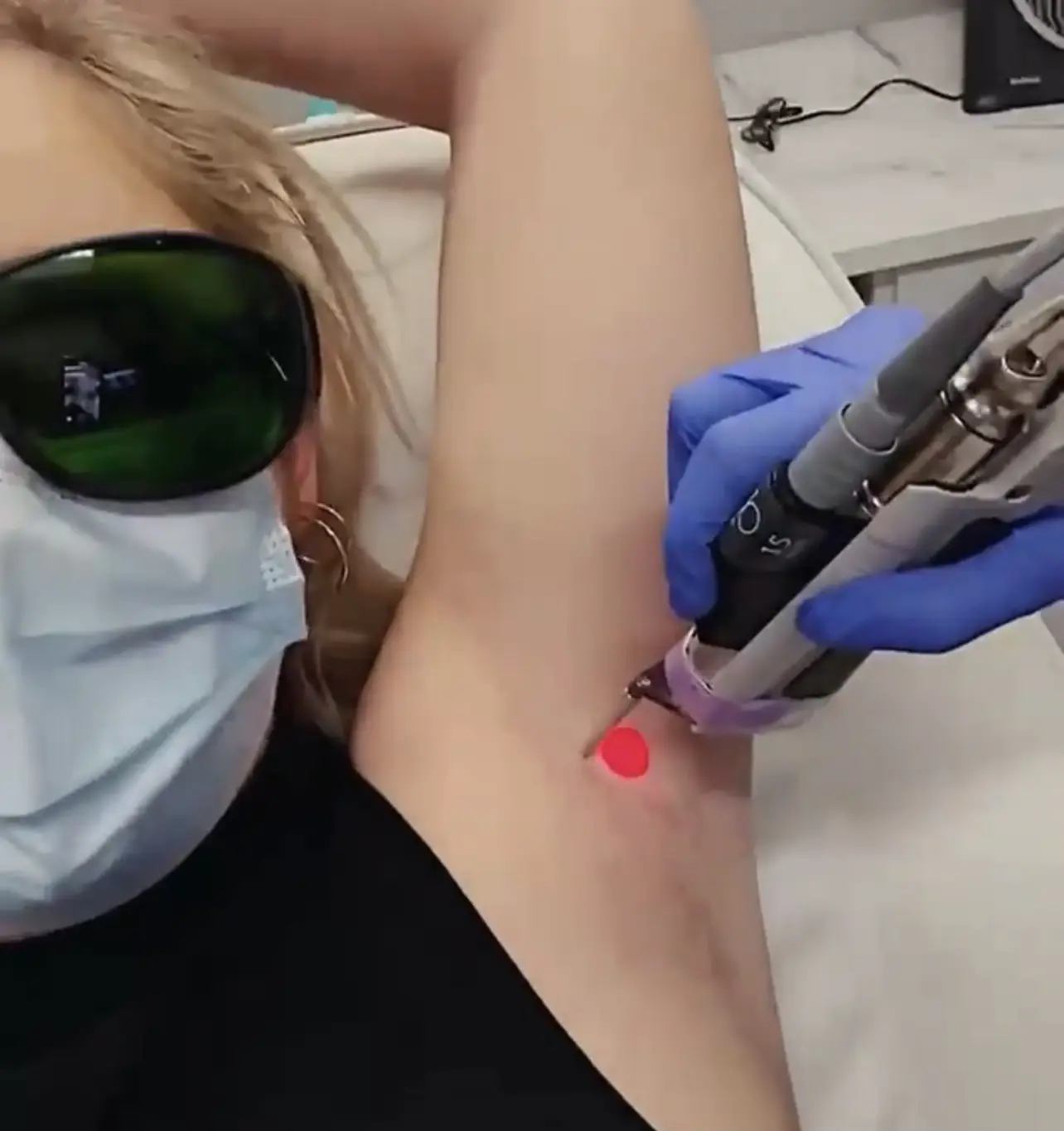 Best Laser Hair Removal Machine