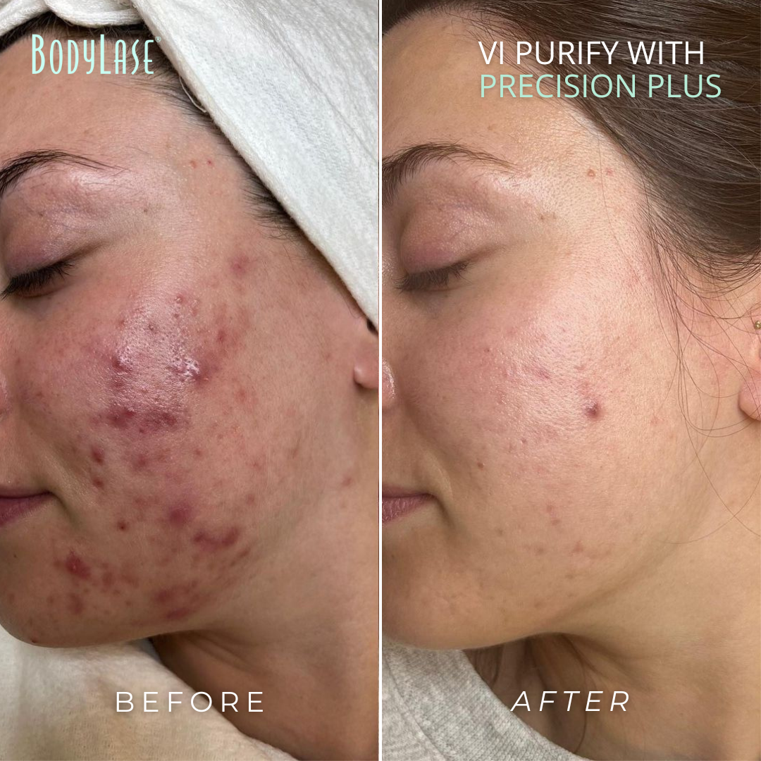 Before and After Chemical Peels