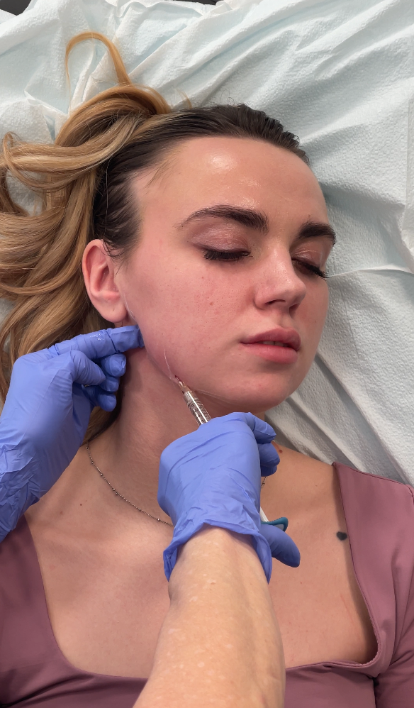 RHA Filler in Raleigh, Cary, Chapel Hill, and Clayton, NC 1 Dermal Fillers