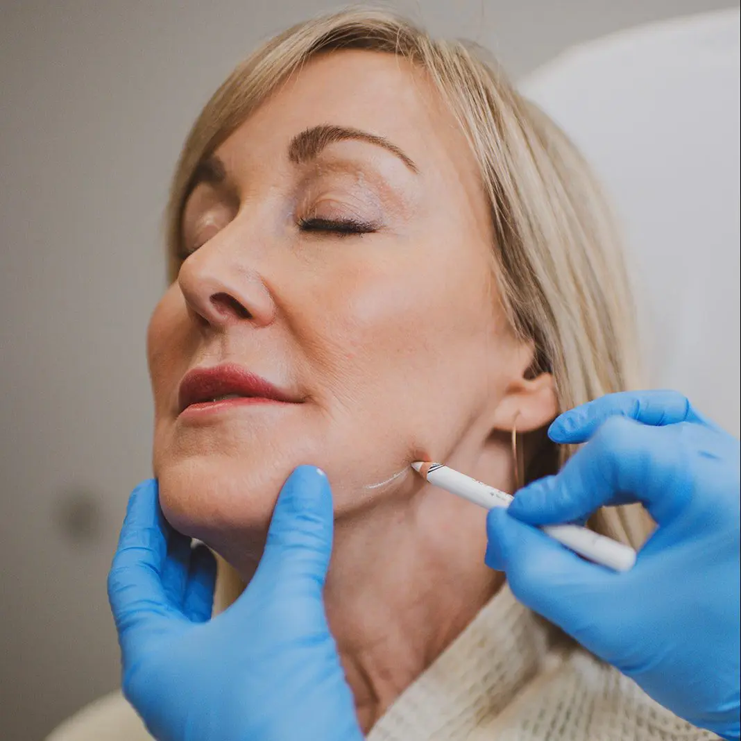 Juvederm Dermal Filler Injections