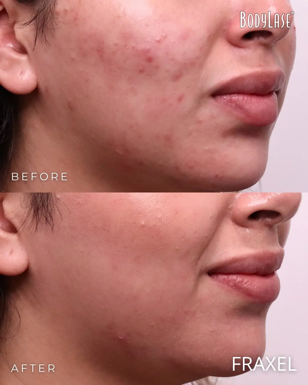 Fraxel® Laser Skin Resurfacing in Raleigh, Cary, and Clayton, NC 5 Fraxel before and after