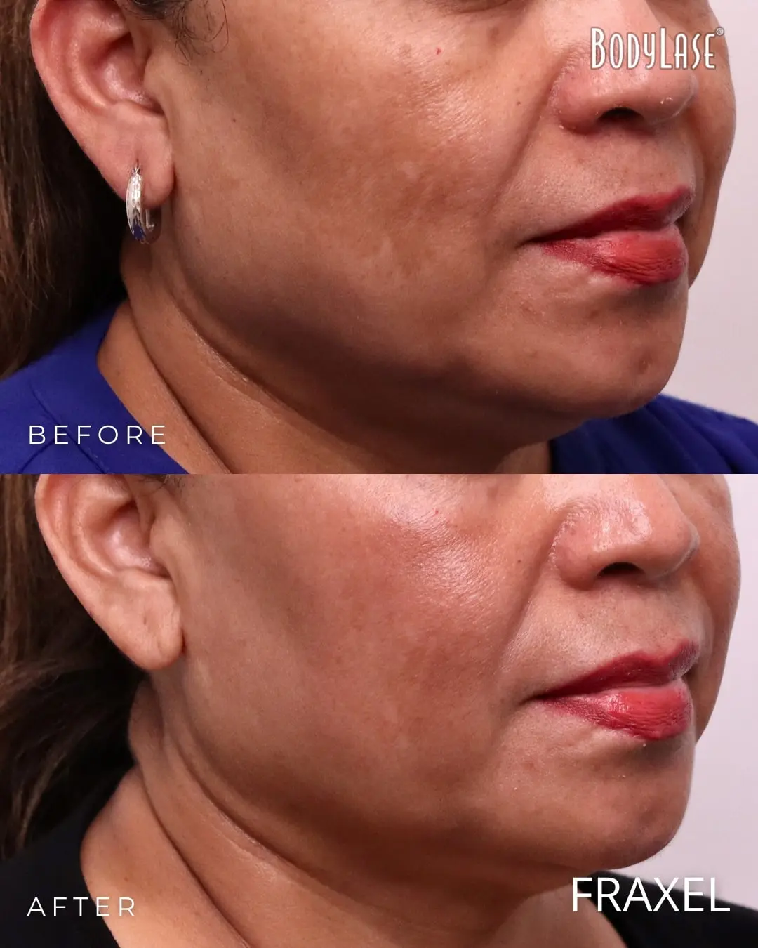 Fraxel® Laser Skin Resurfacing in Raleigh, Cary, and Clayton, NC 8 Fraxel before and after
