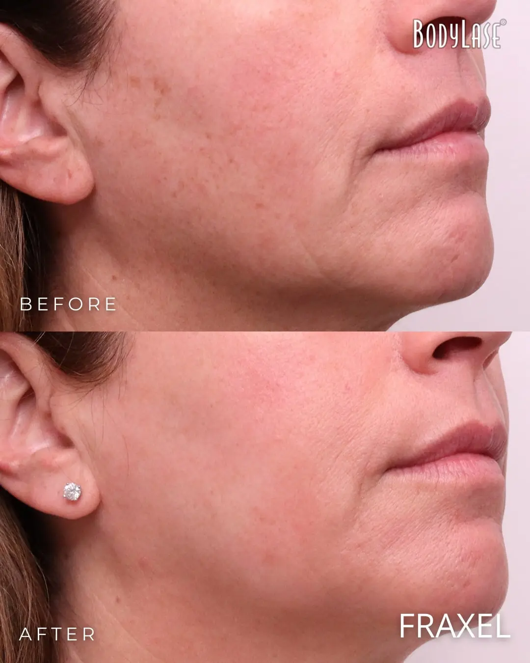 Fraxel® Laser Skin Resurfacing in Raleigh, Cary, and Clayton, NC 10 Fraxel before and after
