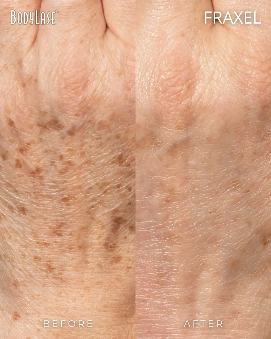 Fraxel® Laser Skin Resurfacing in Raleigh, Cary, and Clayton, NC 9 Fraxel on hands before and after