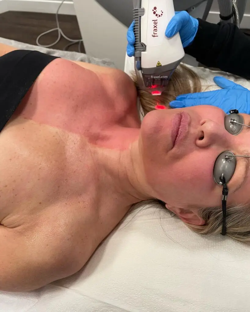 Fraxel Laser Resurfacing