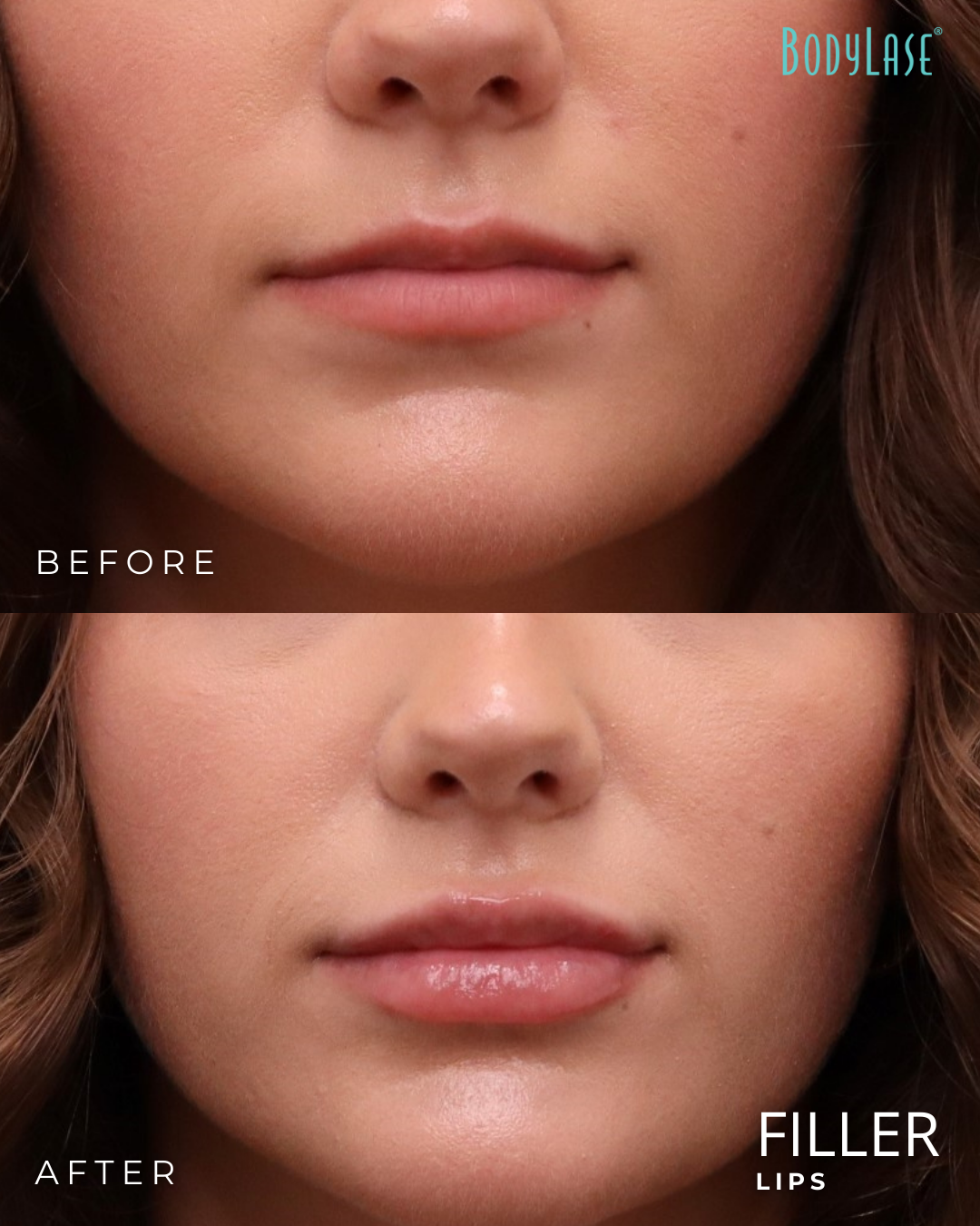 Lip Fillers in Raleigh, Cary, Chapel Hill, and Clayton, NC 4