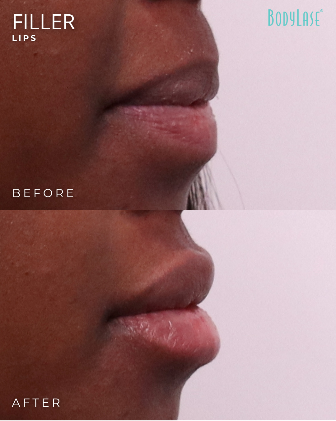 Lip Fillers in Raleigh, Cary, Chapel Hill, and Clayton, NC 3