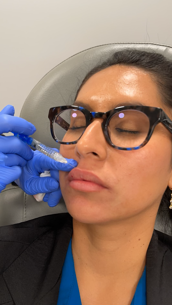 Lip Fillers in Raleigh, Cary, Chapel Hill, and Clayton, NC 1 Lip Filler