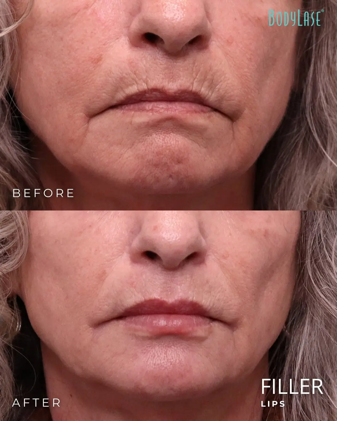 Lip Fillers in Raleigh, Cary, Chapel Hill, and Clayton, NC 5 Lip Filler before and after
