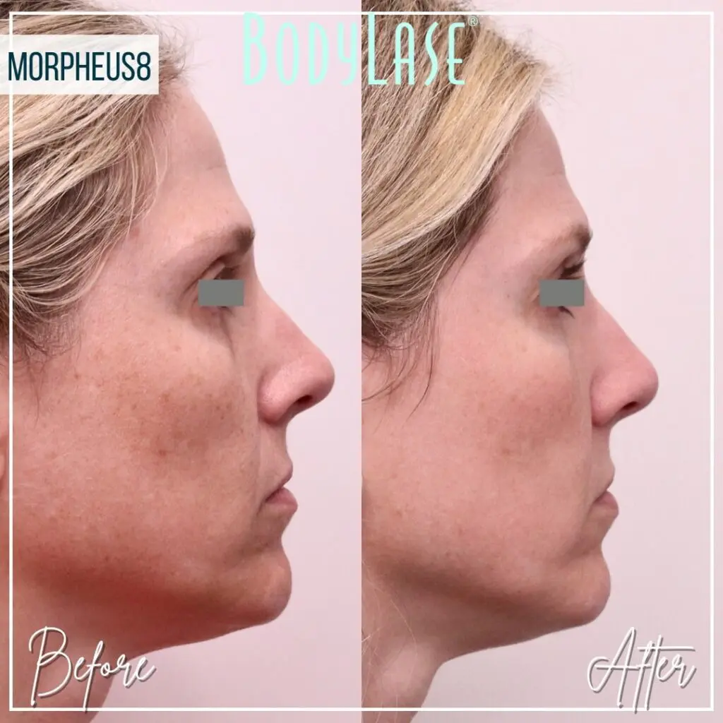 Morpheus8 Before and After