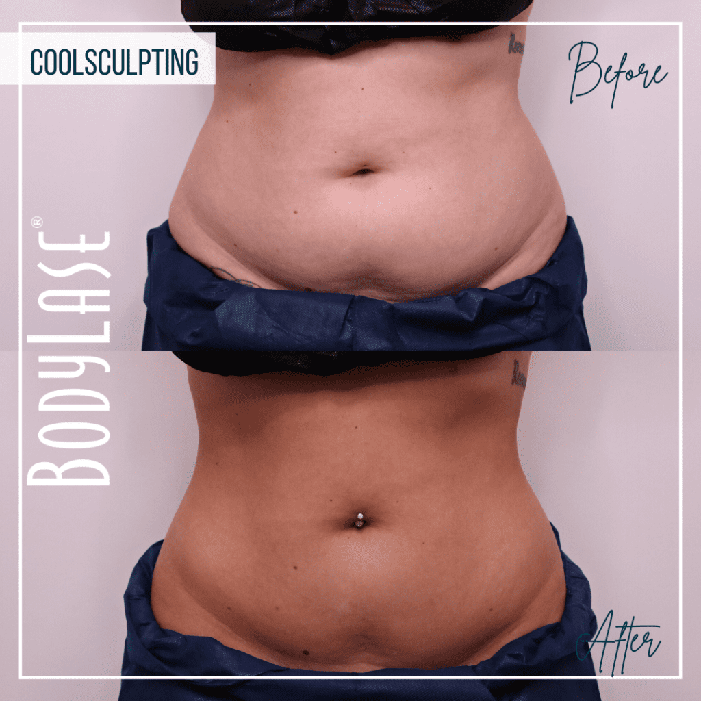 CoolSculpting Elite Before and After: A Complete Guide to the Fat Freezing Procedure 1