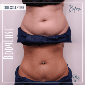 Before and After CoolSculpting