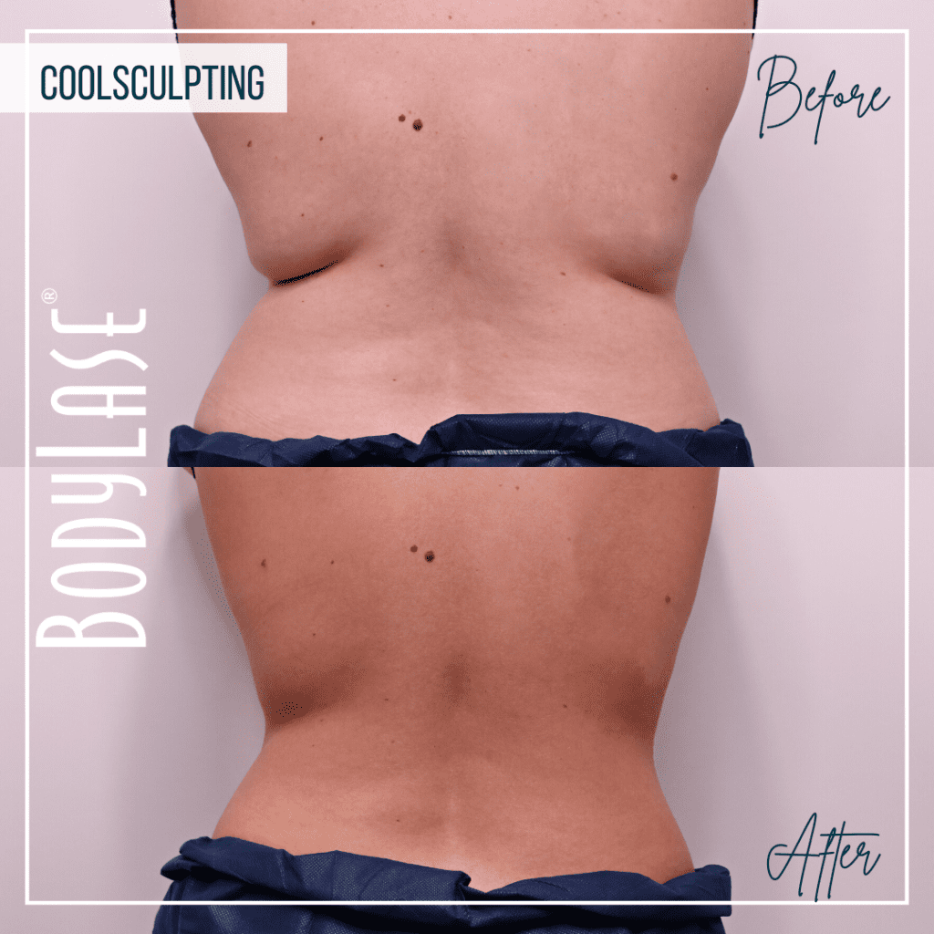 CoolSculpting Elite Before and After: A Complete Guide to the Fat Freezing Procedure 2